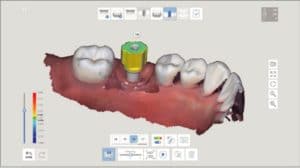A.I. Abutment & A.I. Scan Body Matching